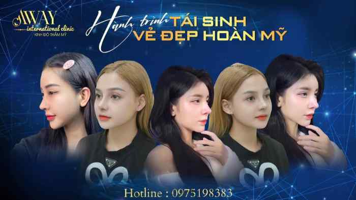 Nga Hoàng - Chuyên nâng mũi/sửa mũi ở Móng Cái