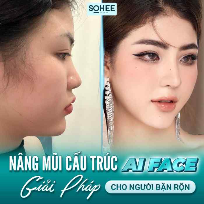 5 Địa chỉ nâng mũi/sửa mũi ở Quảng Ninh hàng đầu 3 Thẩm Mỹ Quốc Tế Sohee Premium - nâng mũi/sửa mũi ở Quảng Ninh