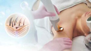 triệt lông ở Hạ Long