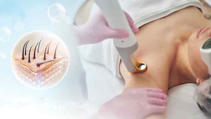 triệt lông ở Hạ Long